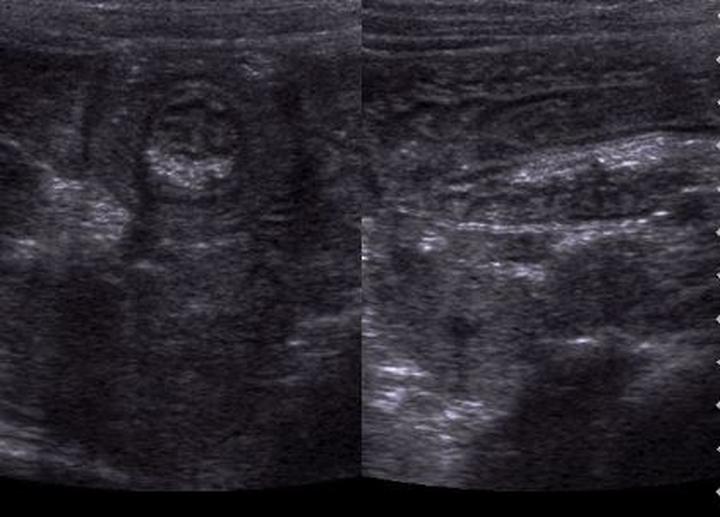 Diagnostyka raka jelita grubego