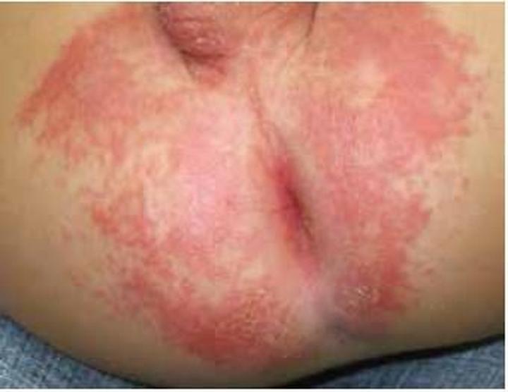 Grzybica odbytu leczenie