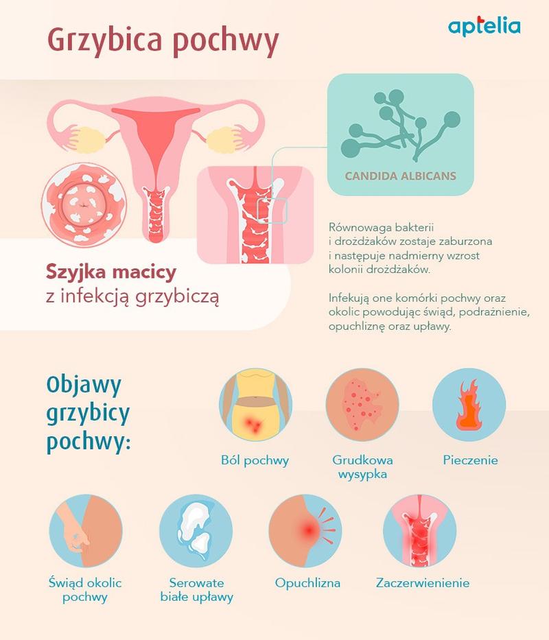 Objawy infekcji pochwy