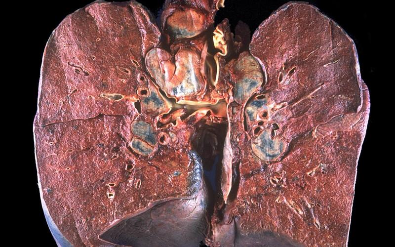 Sarkoidoza skóry diagnoza