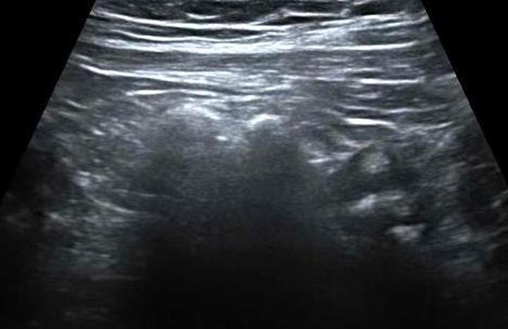 USG a rak jelita grubego