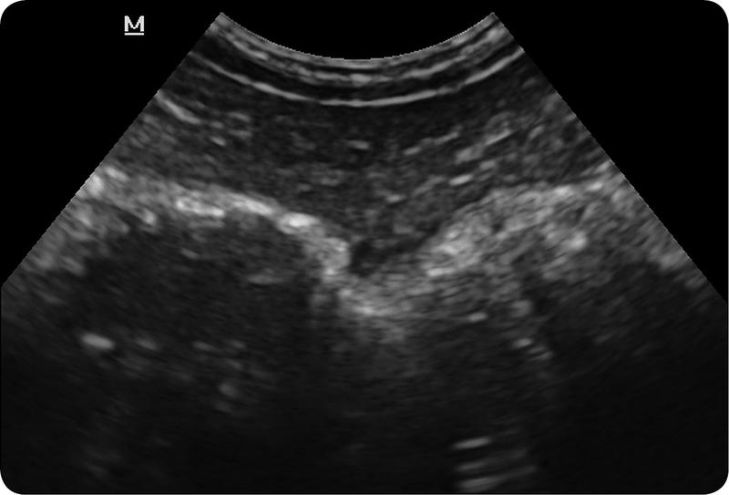 USG w wykrywaniu nowotworów