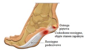 Ból pięty: odkryj niespodziewane przyczyny i skutki, które mogą cię zaskoczyć