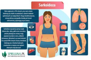 Sarkoidoza skóry: jak skutecznie diagnozować i leczyć tę chorobę?