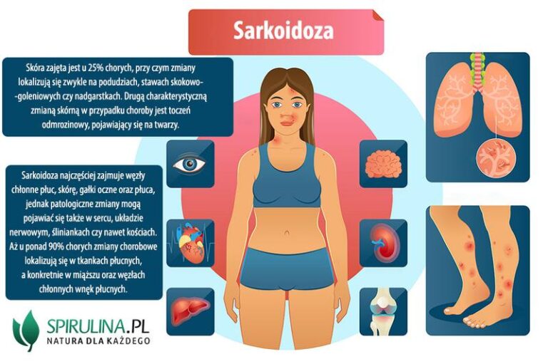 Sarkoidoza skóry: jak skutecznie diagnozować i leczyć tę chorobę?