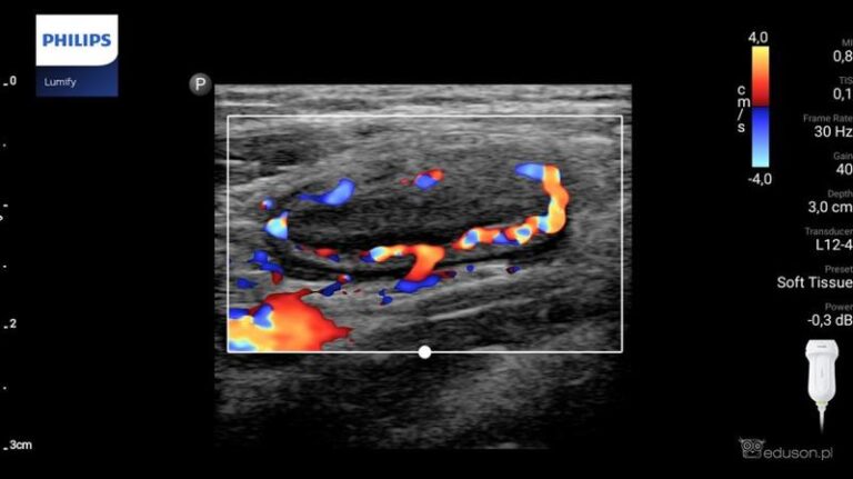 USG a rak jelita grubego: jakie ma ograniczenia i co warto wiedzieć?