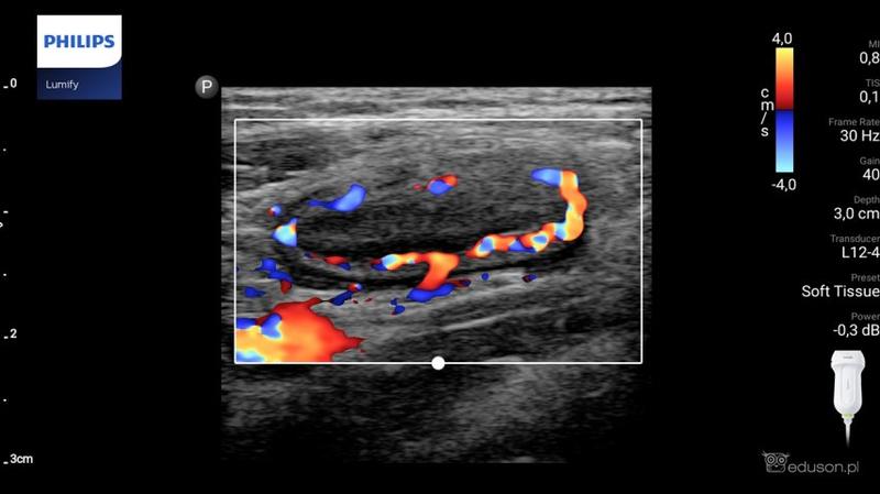 USG a rak jelita grubego: jakie ma ograniczenia i co warto wiedzieć?