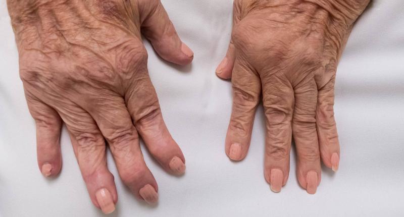 Zapalenie stawów przyczyny