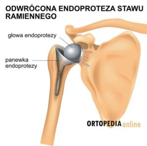 Przygotowanie do operacji endoprotezy: kluczowe badania, które pozwolą uniknąć nieprzyjemnych niespodzianek
