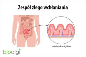 Zespół złego wchłaniania: poznaj 7 objawów i 5 zagrożeń dla twojego zdrowia
