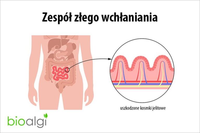 Zespół złego wchłaniania: poznaj 7 objawów i 5 zagrożeń dla twojego zdrowia