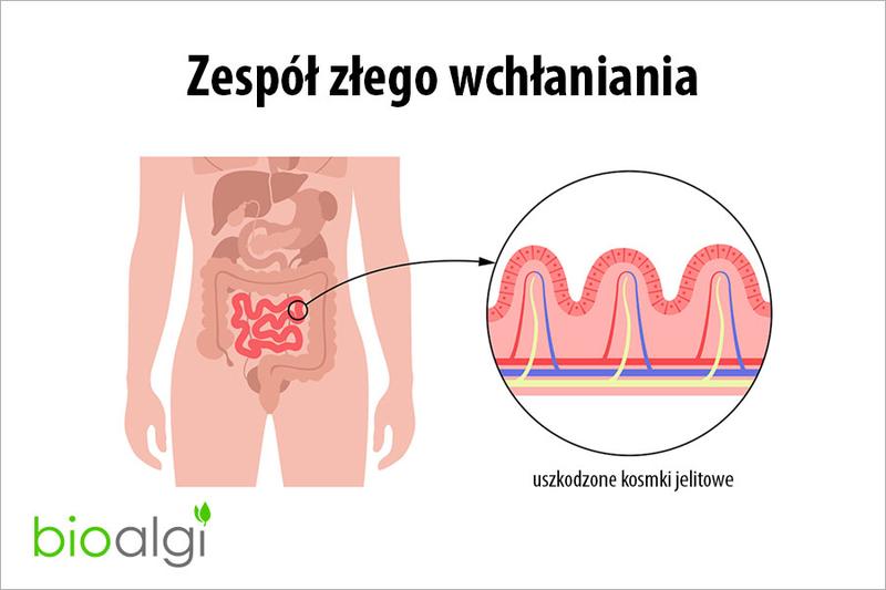 Zespół złego wchłaniania: poznaj 7 objawów i 5 zagrożeń dla twojego zdrowia