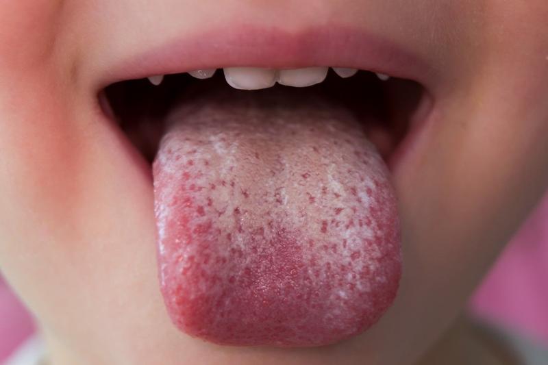 Objawy drożdżaków u dzieci