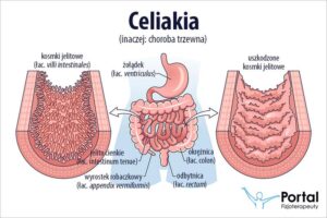 Celiakia a objawy skórne: Przewodnik z ilustracjami i najważniejszymi informacjami