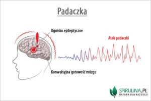 Jak rozpoznać objawy padaczki i skutecznie udzielić pierwszej pomocy podczas napadu?