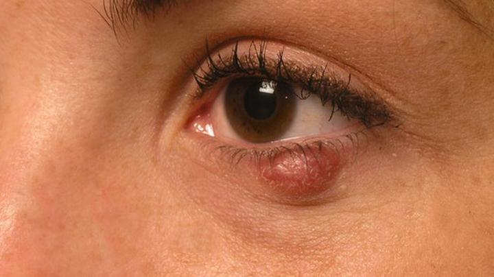 Domowe sposoby na gradówki