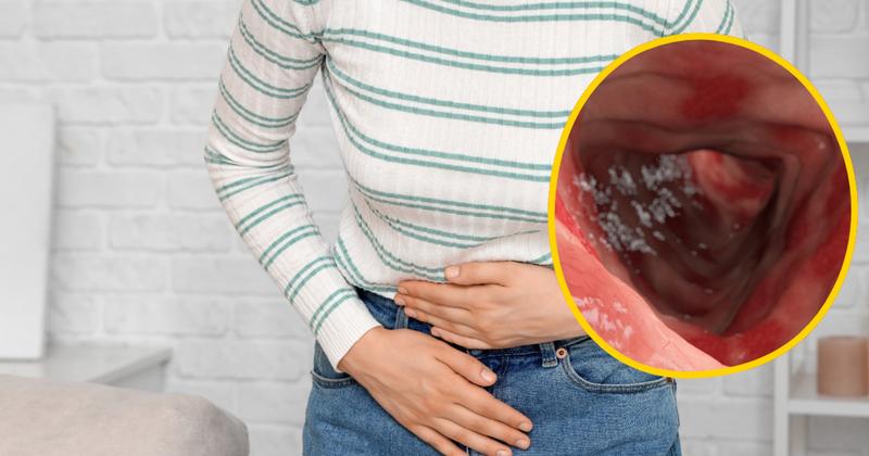 Kiedy iść do specjalisty przy zapaleniu jelit