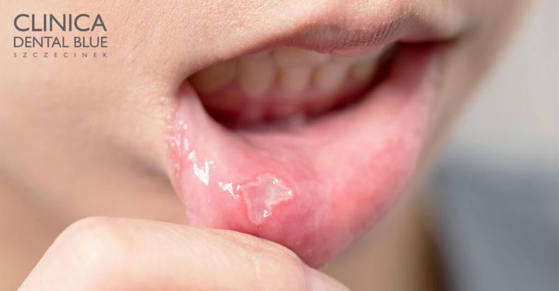 Leczenie pleśniawek u malucha