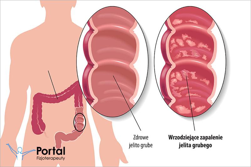 Monitorowanie zdrowia jelit