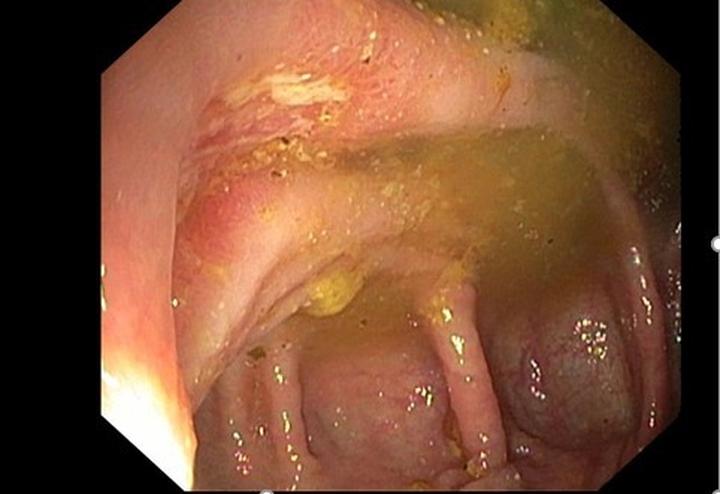 Naturalne sposoby na zapalenie jelit