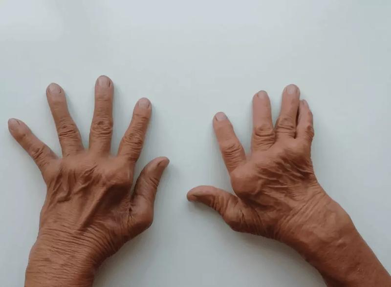 Nowoczesne leki biologiczne w RZS