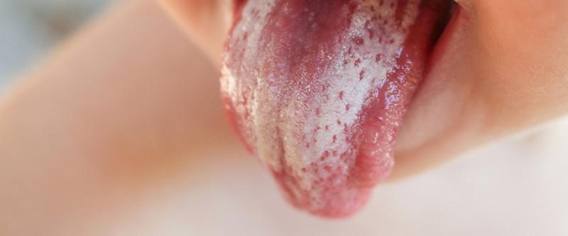 Pleśniawki u dzieci