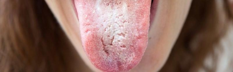 Jak rozpoznać kandydozę? Oto 8 sygnałów i skuteczna diagnostyka