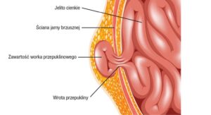 Jak rozpoznać niebezpieczne sygnały przepukliny jelita grubego? Objawy, które warto znać!
