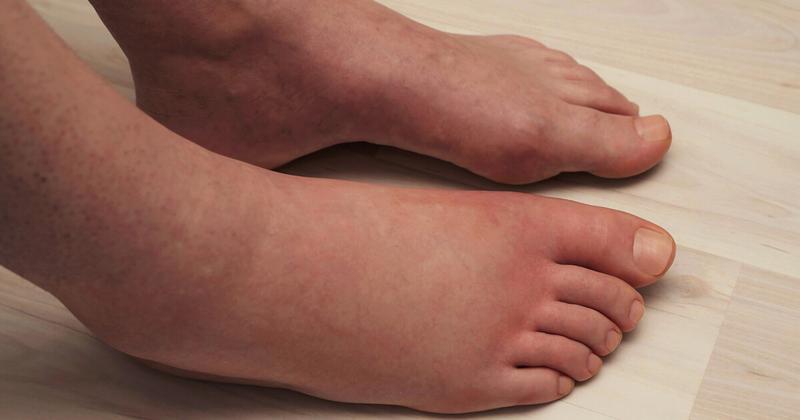 Obrzęk stawów: zrozumienie przyczyn i skuteczne metody leczenia w różnych przypadkach