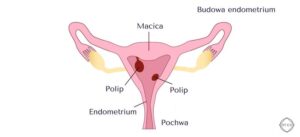 Przewlekłe zapalenie endometrium: jak rozpoznać objawy i skutecznie leczyć?