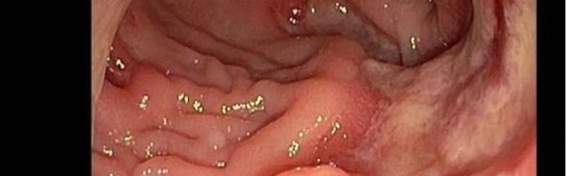Zauważ te 7 objawów stanu zapalnego jelit, żeby nie przegapić problemu zdrowotnego