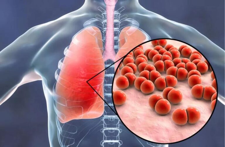 Pięć niebezpiecznych zapaleń dróg oddechowych: kluczowe objawy, które warto znać