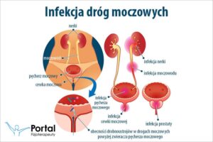 Pieczenie i ból przy oddawaniu moczu po stosunku – jak sobie z tym radzić?